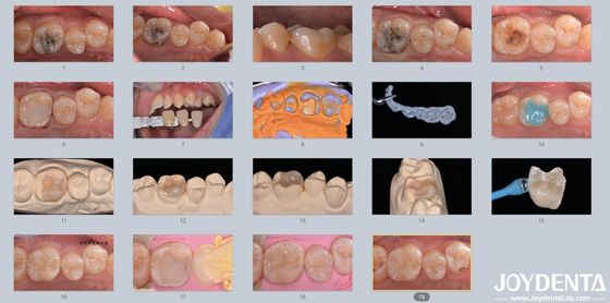 Yetişkinler Çocuklar Porselen Keramik Diş Yapısı Hasarlı Dişler için Restoratif