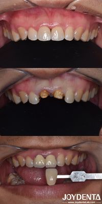 Biyolojik olarak yönlendirilmiş hazırlama tekniği Dental dikey hazırlama En az invaziv