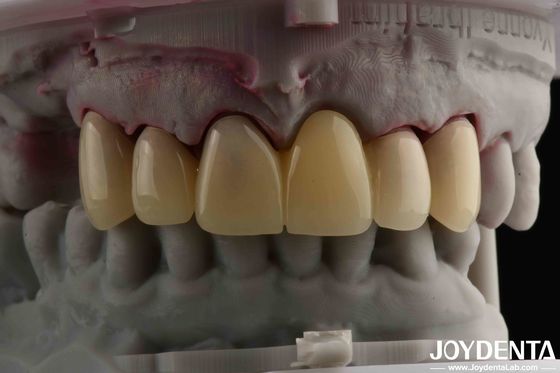 Doğal gölge geçişleri için CAD CAM İşleme Diş PMMA Malzeme Çok Katmanlı Tasarım