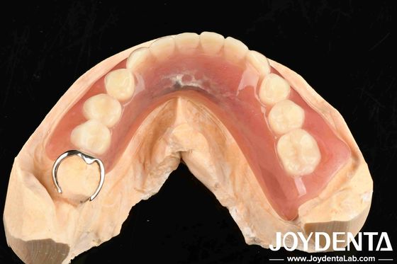 Metaller ve reçinler Çerçeve, Diş Yapısındaki Sabit Ağız Yapısı için Diş Dönüşümü Yapısı
