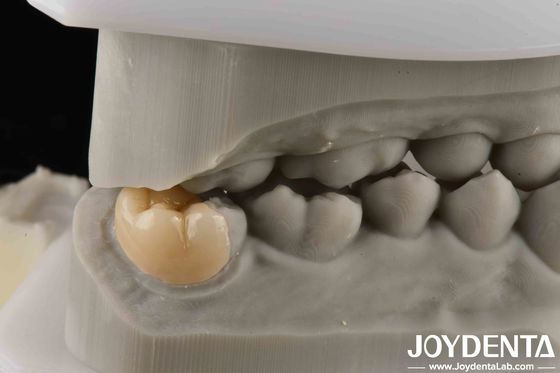 Yüksek Güçlü Emax İyi Şeffaflık Şeffaf Performans İçin Emax Inlay Onlay
