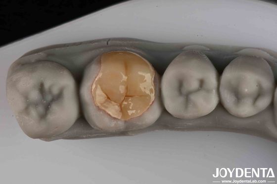 Kullanım ve yırtılmaya karşı iyi şeffaflık düşük dayanıklılık Emax Inlay Onlay operasyonel verimliliğiniz için