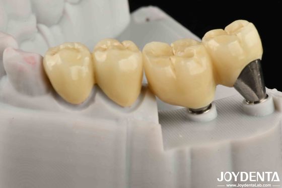 Doğal görünümlü İmplant Tacı ve Köprüsü Oral Uzun Süren Performans için Güvenli