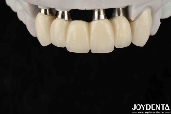 Güvenli Oral Biyolojik Uyumluluk için Özel Yapılandırılabilir İmplant Tacı ve Köprüsü