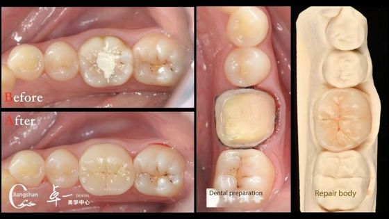 Biyolojik uyumluluk ve doğal diş restorasyonu ile yüksek uyumluluk