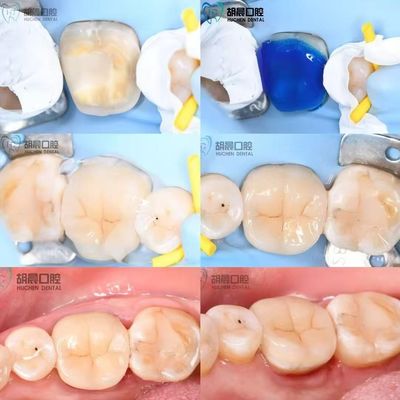 Dental Inlay'in hassasiyetini deneyin.