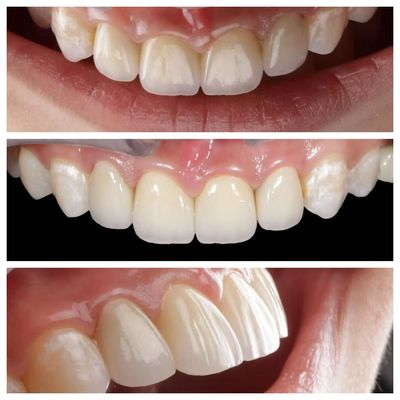 Ön diş göstergesi 0.5 mm kalınlığı ve mükemmel geçirgenliği olan diş kaplamaları