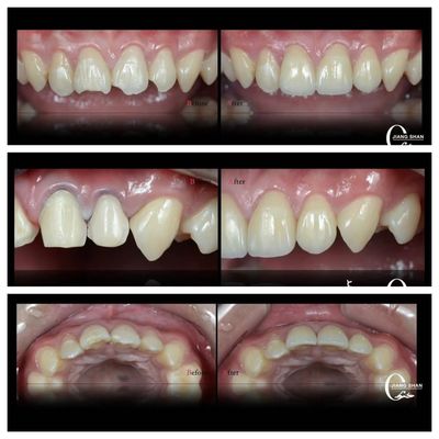 Doğal ve Güzel Gülümsemek İçin Doğal Diş Finerleri