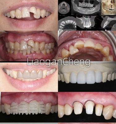 Biyolojik uyumluluk Uzun süreli ve implant destekli restorasyonlar için güvenli zirkonya diş taçları