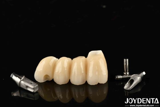 Kusursuz fonksiyon için porselenle yapılmış özelleştirilebilir implant tacı ve köprüsü.