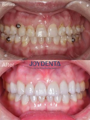 Porselen Veneer Ağız Restorasyonu