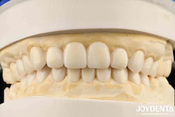 Diş Biyomimetik Estetik Tanısal Veneer Wax-Up'ı