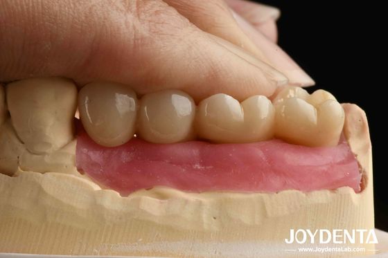 Ultra hassas işleme Zirkonya implantları tüm zirkonyumlu entegre taç için yapay zeka destekli tasarım ve biyonik dişeti delme