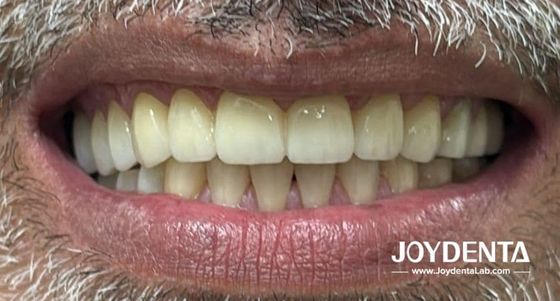 Doğal dişleri taklit eden zirkonya protezleri