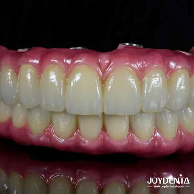 Hafif Diş Titanyum Malong Hibrit Köprüsü Diş Restorasyonu İçin Rahat