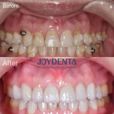 Eksik Dişler İçin Diş Fenerleri Global Premium Diş Laboratuvarı Hizmetleri