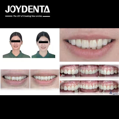 Joydentalab'ın popüler ürünleri: Simülasyonlu estetik kaplamalar