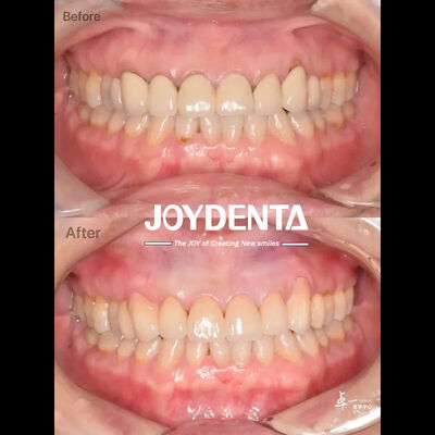 Güvenli Ağız Dokusu ve CAD / CAM Uyumluluğu İçin Diş Zirkonyası