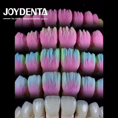 The Joydenta Ceramic Veneer Process